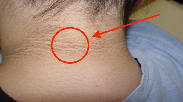 Ảnh 1 của Acanthosis Nigricans